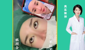 眼综合四项