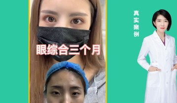 眼综合3个月效果